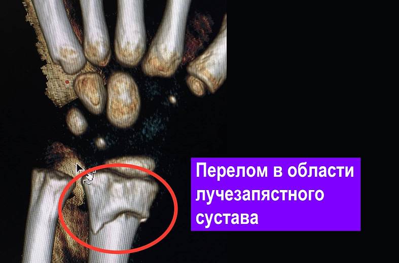 КТ лучезапястного сустава