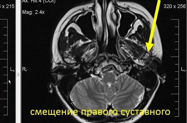 МРТ-исследование височно-нижнечелюстных суставов