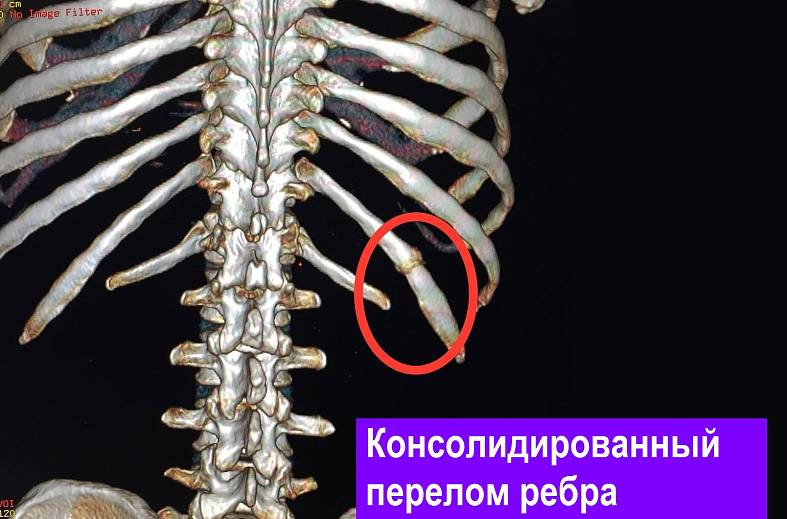 КТ органов грудной клетки 