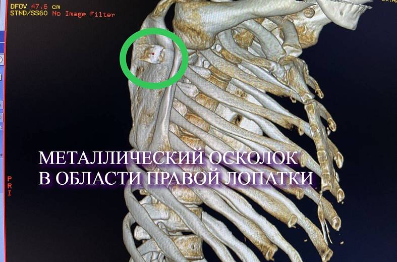 КТ плечевого сустава