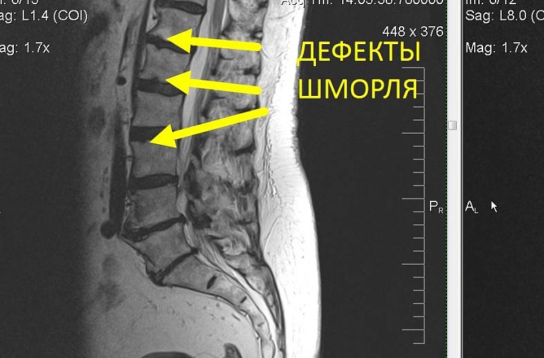 МРТ пояснично-крестцового отдела позвоночника