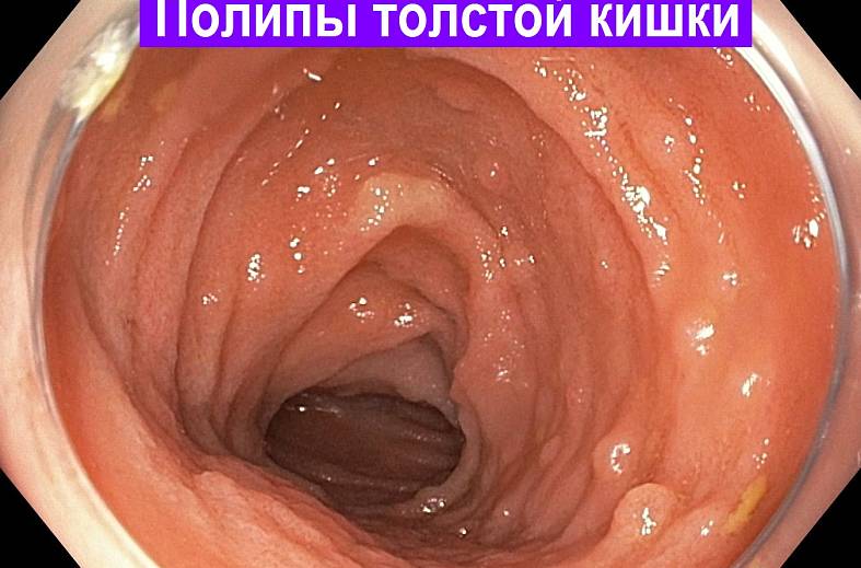 Видеоколоноскопия экспертного класса на аппарате Pentax i7010 (Япония) expert
