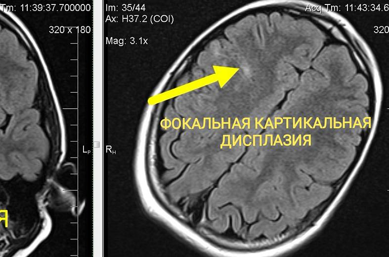 Высокопольная МРТ головного мозга по программе эпилептологического сканирования