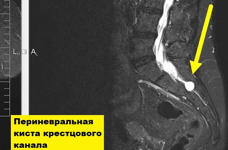 МРТ пояснично-крестцового и крестцово-копчикового отдела позвоночника