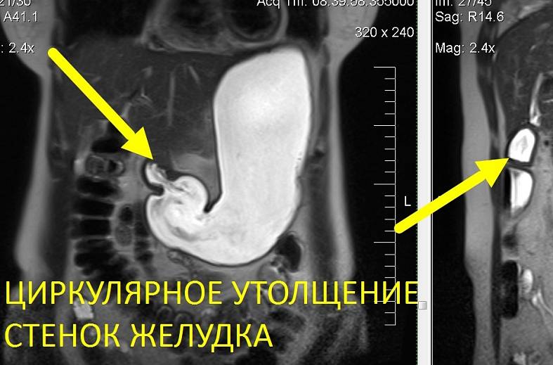МРТ-желудка с пероральным контрастированием