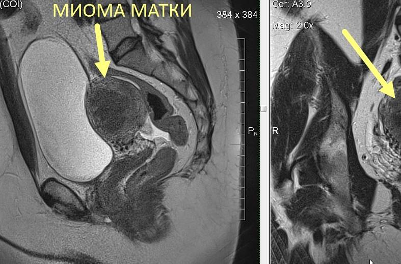 МРТ органов женского малого таза (матка, яичники, мочевой пузырь, влагалище, сосуды малого таза, лимфатические узлы)