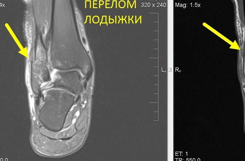МРТ голеностопного сустава