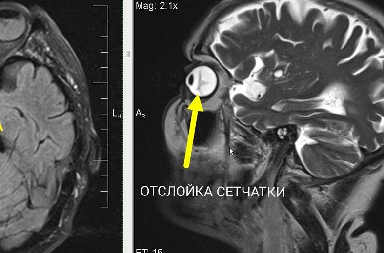 МРТ глазных орбит и зрительных нервов