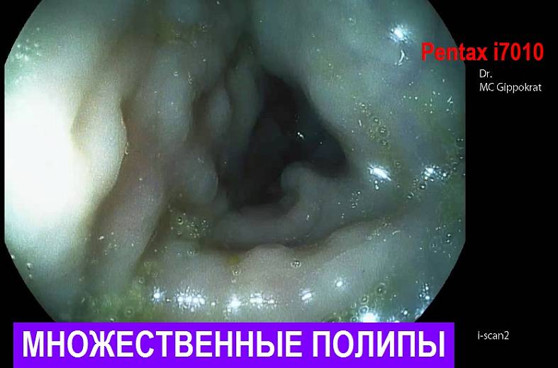 Видеоколоноскопия экспертного класса на аппарате Pentax i7010 (Япония) expert