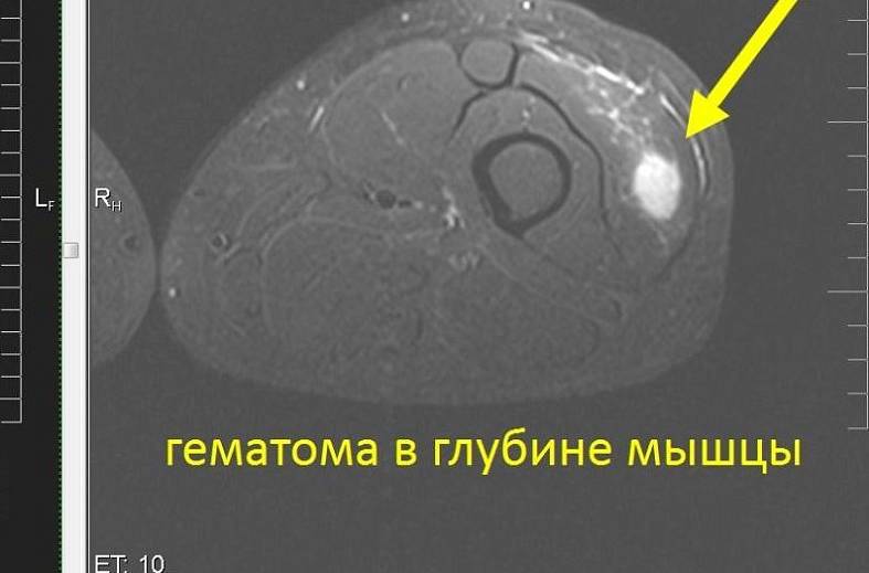МРТ мягких тканей конечности (одна область)