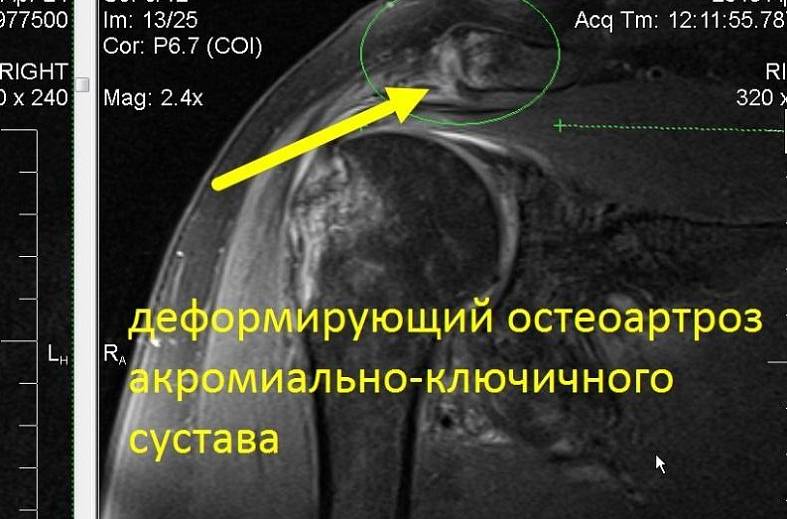 МРТ плечевого сустава