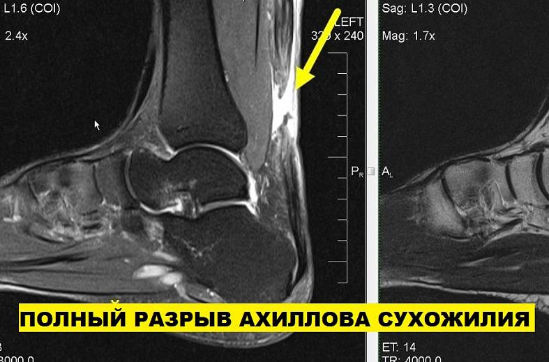 МРТ голеностопного сустава