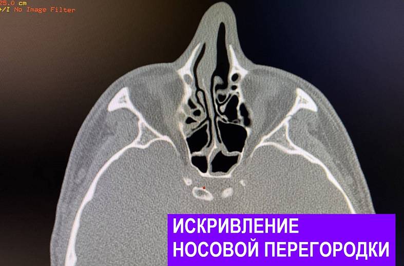 КТ придаточных пазух носа