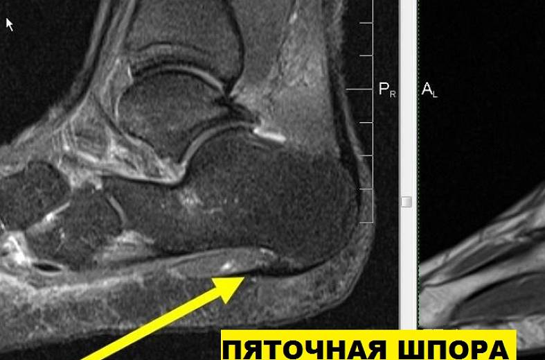 МРТ голеностопного сустава