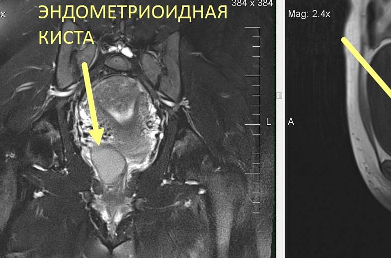 МРТ органов женского малого таза (матка, яичники, мочевой пузырь, влагалище, сосуды малого таза, лимфатические узлы)