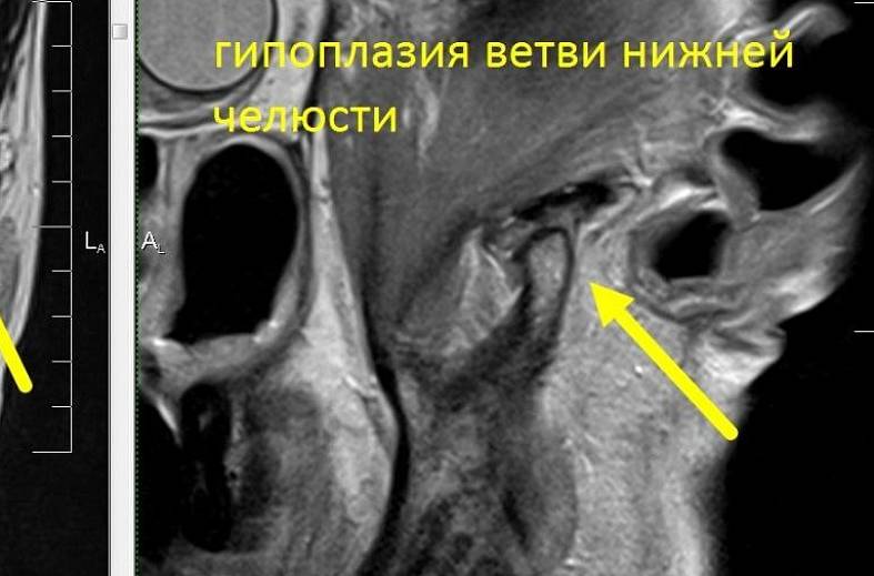 МРТ-исследование височно-нижнечелюстных суставов
