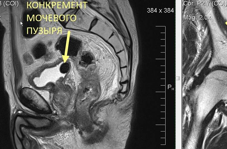 Диффузно-взвешенное магнитно-резонансное изображение (DWI MRI) ( для обеспечивания контрастности картинки)