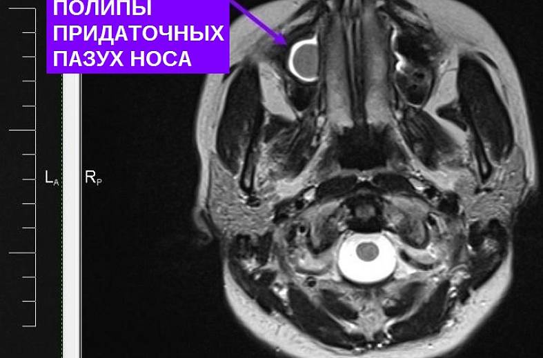 МРТ придаточных пазух носа