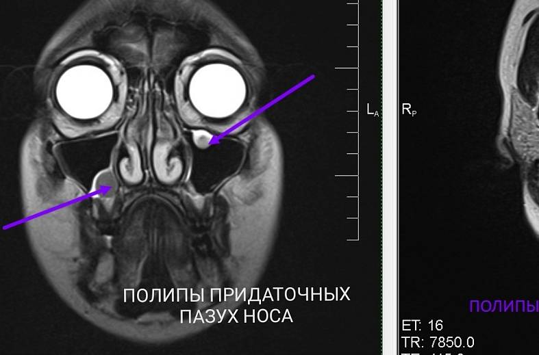 МРТ придаточных пазух носа