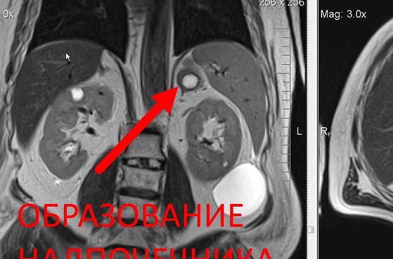 МРТ органов забрюшинного пространства (почки, надпочечники, нижняя полая вена, лимфатические узлы, брюшной отдел аорты)