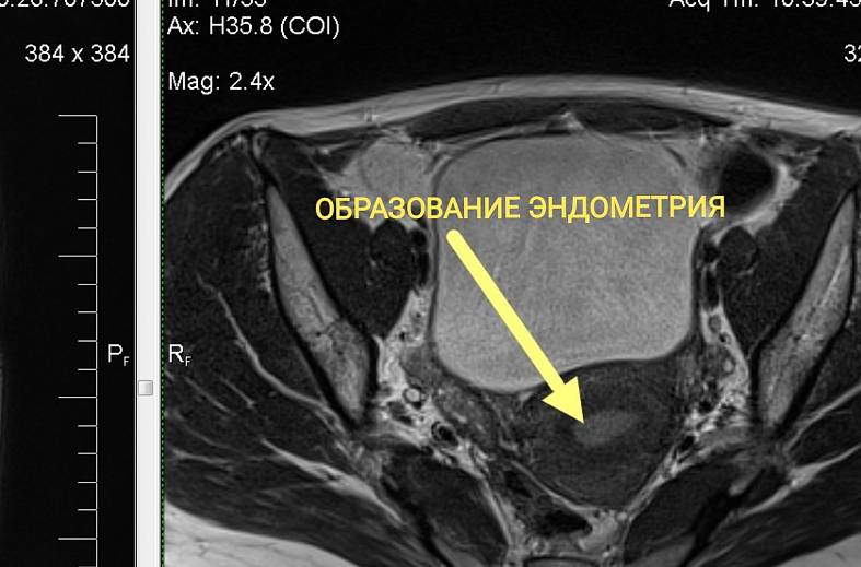 МРТ органов женского малого таза (матка, яичники, мочевой пузырь, влагалище, сосуды малого таза, лимфатические узлы)