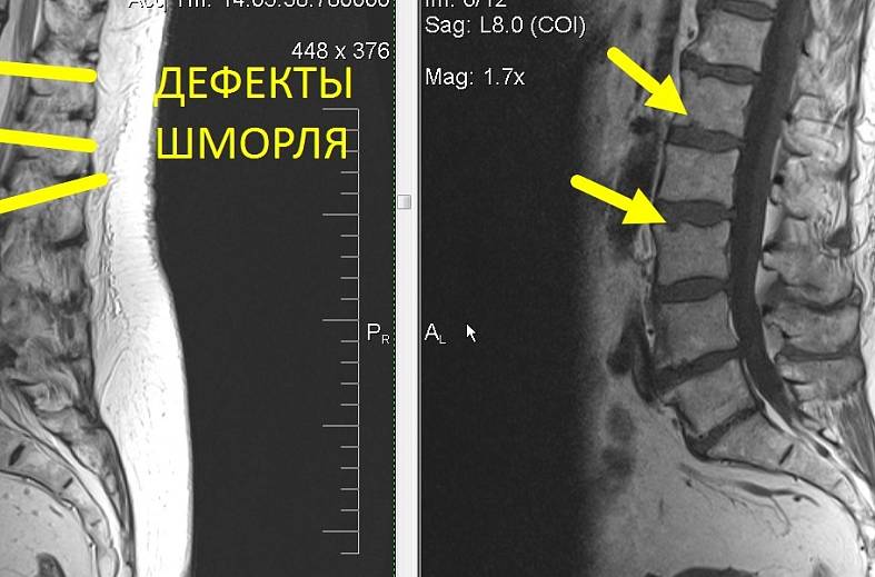 МРТ пояснично-крестцового отдела позвоночника