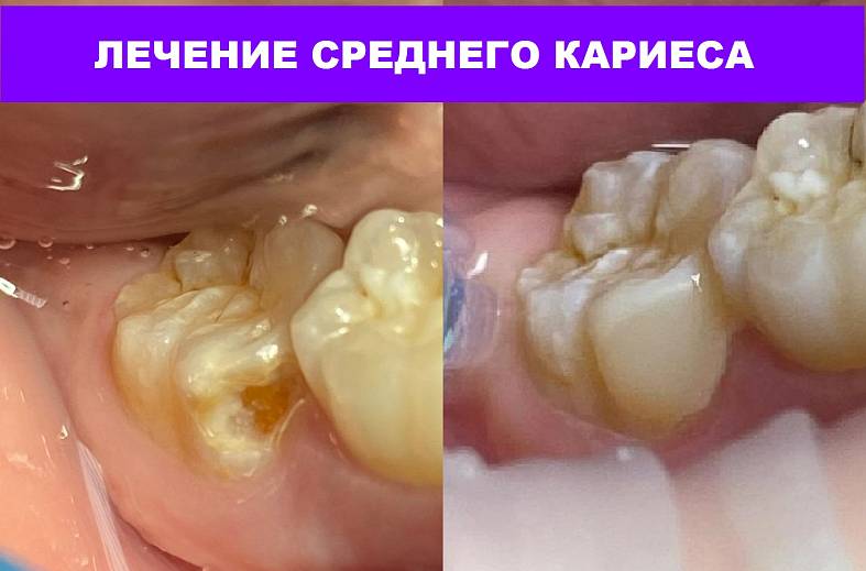 Лечение среднего кариеса