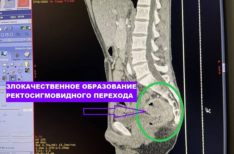 КТ толстой кишки, виртуальная колоноскопия