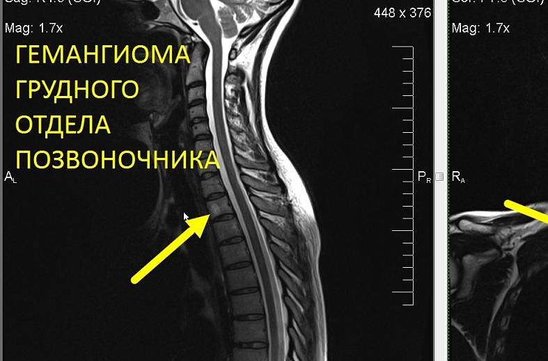 МРТ грудного отдела позвоночника