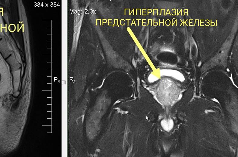 Диффузно-взвешенное магнитно-резонансное изображение (DWI MRI) ( для обеспечивания контрастности картинки)