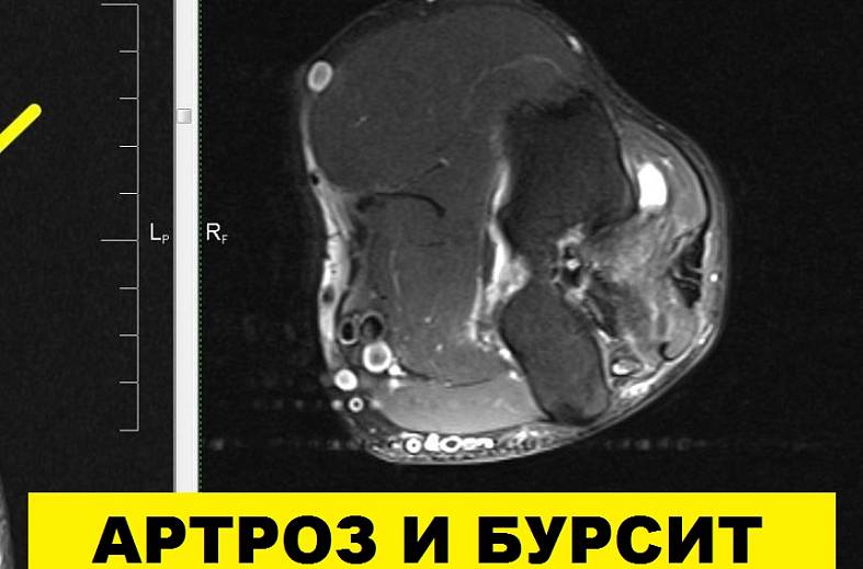 МРТ локтевого сустава