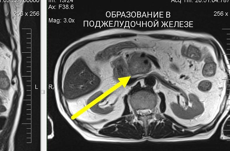 МРТ органов брюшной полости и холангиография (детальный осмотр внутри и вне печеночных желчных протоков)