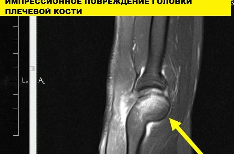 МРТ плечевого сустава