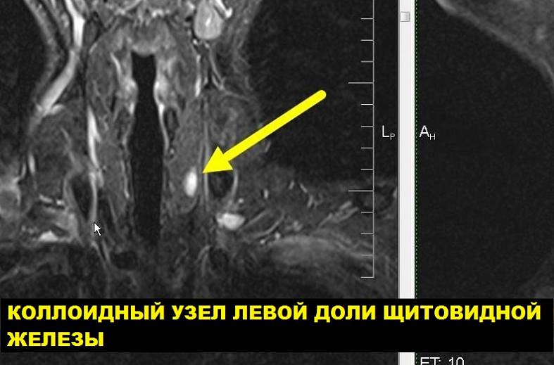 МРТ исследование щитовидной железы