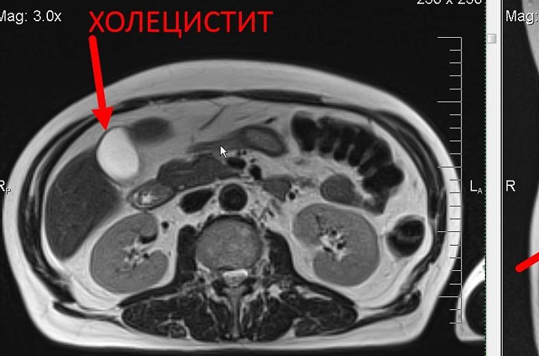 МРТ органов брюшной полости и холангиография (детальный осмотр внутри и вне печеночных желчных протоков)