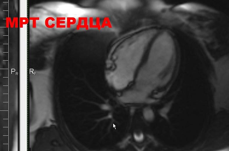 МРТ сердца + контрастирование