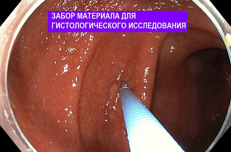Видеоколоноскопия экспертного класса на аппарате Pentax i7010 (Япония) expert
