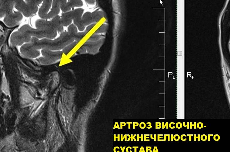 МРТ-исследование височно-нижнечелюстных суставов