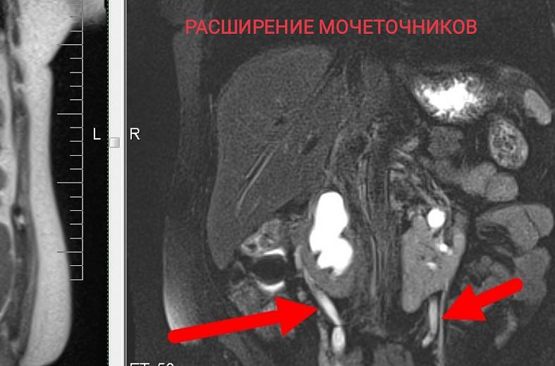 МР-исследование почек + МР-урография