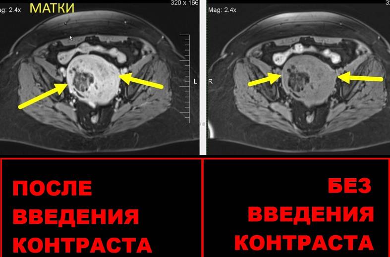 Контрастирование препаратом при МРТ