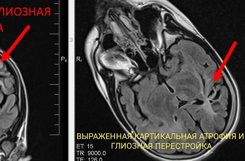 Высокопольная МРТ головного мозга по программе эпилептологического сканирования