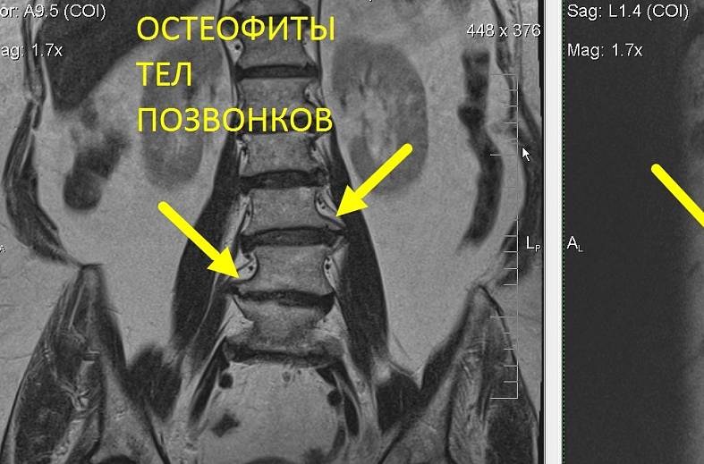 МРТ пояснично-крестцового отдела позвоночника