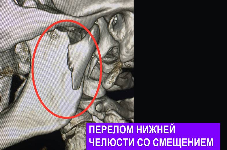 КТ лицевого скелета