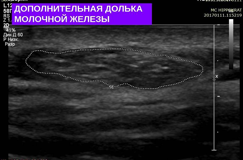 УЗИ молочных желез с допплеровским исследованием (0-3 размер) на аппарате элитного класса