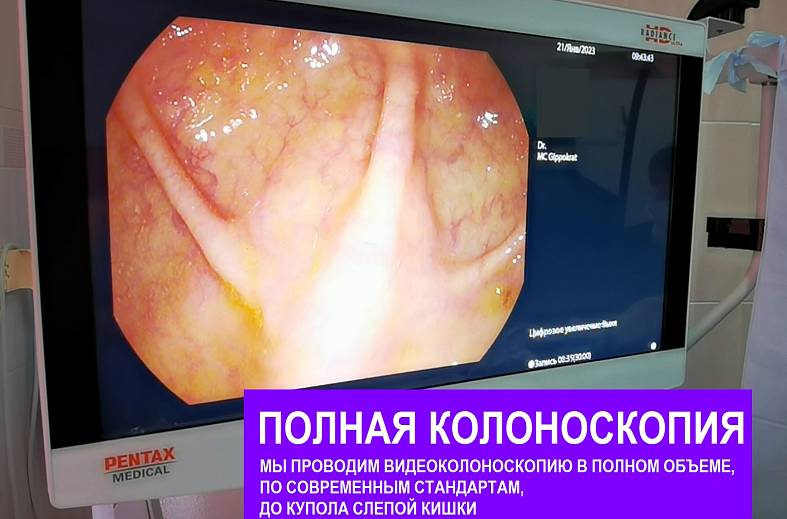 Видеоколоноскопия экспертного класса на аппарате Pentax i7010 (Япония) expert