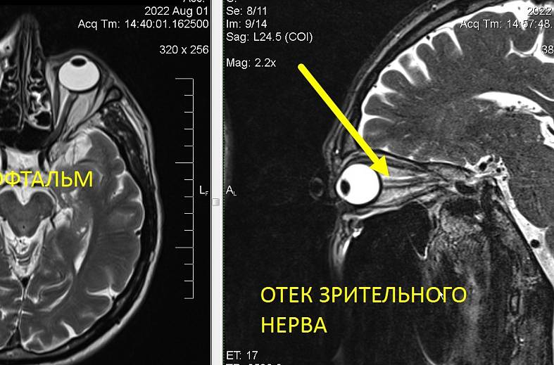 МРТ глазных орбит и зрительных нервов