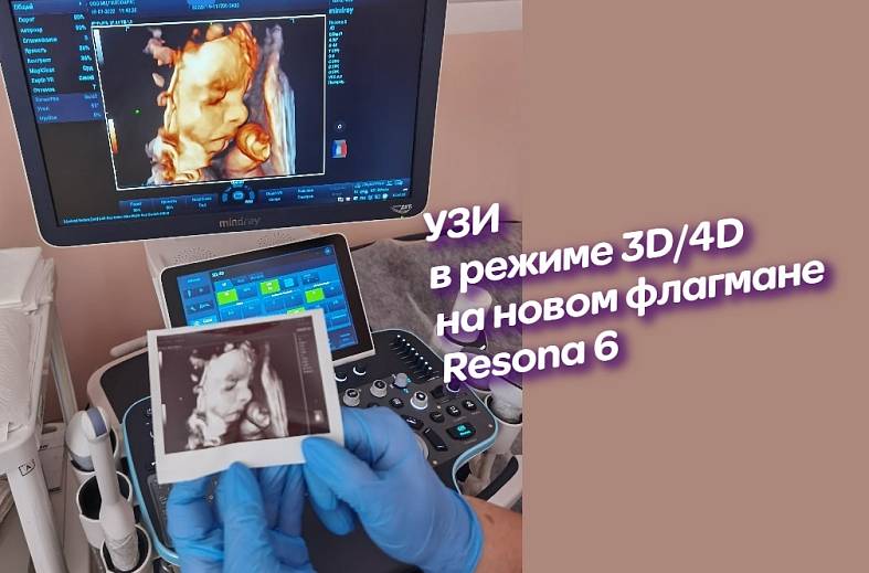 УЗИ плода 2 триместр на аппарате элитного класса
