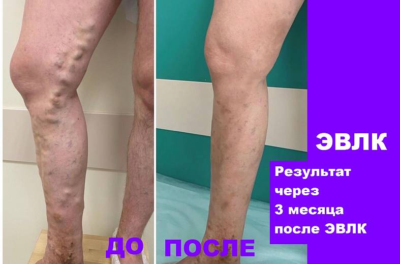 Эндовенозная лазерная коагуляция - ЭВЛК одной магистральной вены нижней конечности ( лазерным аппаратом "FiberLase S")