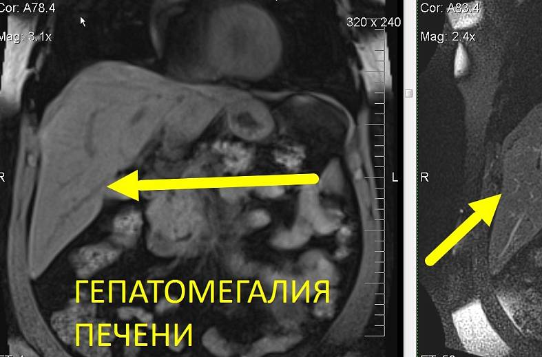 МРТ органов брюшной полости и холангиография (детальный осмотр внутри и вне печеночных желчных протоков)