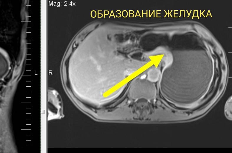 МРТ-желудка с пероральным контрастированием
